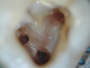 Wurzelbehandlung, Geöffnete und saubere Wurzelkanäle Wurzelbehandlung, Geöffnete und saubere Wurzelkanäle