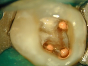 Wurzelfüllung an drei Wurzelkanälen, Wurzelbehandlung Wurzelfüllung an drei Wurzelkanälen, Wurzelbehandlung