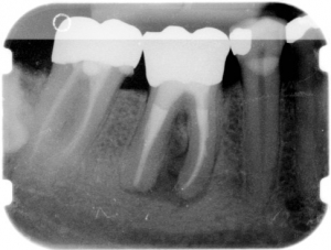 Nach der Wurzelbehandlung Nach der Wurzelbehandlung