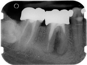 Vor der Wurzelbehandlung Vor der Wurzelbehandlung