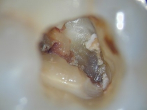 Wurzelbehandlung-Geöffneter wurzelerkrankter Zahn, Kanäle noch nicht aufbereitet Wurzelbehandlung-Wurzelerkrankter Zahn, geöffnet